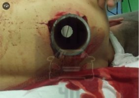 Норильские врачи прооперировали водителя, которого насквозь пронзило трубой после ДТП.
Сообщается, что ДТП произошло в норильском районе Талнах около 7 утра.
По данным ГИБДД, 31-летний водитель Audi A4 не был пристегнут.
Предварительно, он не справился с управлением и врезался в дорожное ограждение из труб. После этого иномарку развернуло, она врезалась в ограждение с другой стороны дороги и слетела в кювет.