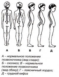 Если не считать лордоза поясничного отдела позвоночника, то просто замечательные.
Вариант Г на картинке.