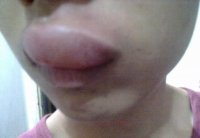 Укус пчелю увеличивает губы не хуже ботокса.