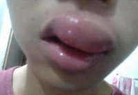 Укус пчелю увеличивает губы не хуже ботокса.