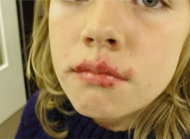 Достаточно просто написать в гугле "опасность герпеса для младенцев" чтобы посмотрев фотки навсегда отбить охоту делиться своими болячками с детьми. Но любвеобильные мудаки об этом не задумываются. Они же ЛЮБЯТ своих детей в отличие от нас, не целующих в губы.