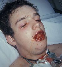 Ну тотальный дебилизм с этими биохакерами... На фото классический результат введения грязного белка или тем более "новосгенеренного". Называется острый анафилактический шок. Они думают нахрена мы делаем максимально человеческие лекарственные белки и чистим их до 99,9 чистоты? 
ЗЫ: Я руководитель лаборатории, разрабатывающей лекарственные белки. Так что такие шутки и хайпы из серии "русской рулетки" с 4 патронами из 6...