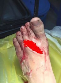 Тупой фейк. Ищем по картинке раненую ногу - и попадаем на вьетнамский медицинский сайт, от 2014 года, на котором объясняют медпомощь при подобных ранениях:

Rửa lại bằng nước muối NaCl 0.9% rồi sát trùng bằng povidine vết thương và vùng xung quanh.
Đắp gạc, cuốn băng thun bó chặt cầm máu.
_______________________________
Промыть 0,9% солевым раствором NaCl, а затем продезинфицировать рану и прилегающую областью. Приложите марлю и плотную повязку, чтобы остановить кровотечение.

Рану закрашу - чтоб никого не нервировать.
сам сайт с фото этой ноги