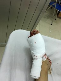 Тупой фейк. Ищем по картинке раненую ногу - и попадаем на вьетнамский медицинский сайт, от 2014 года, на котором объясняют медпомощь при подобных ранениях:

Rửa lại bằng nước muối NaCl 0.9% rồi sát trùng bằng povidine vết thương và vùng xung quanh.
Đắp gạc, cuốn băng thun bó chặt cầm máu.
_______________________________
Промыть 0,9% солевым раствором NaCl, а затем продезинфицировать рану и прилегающую областью. Приложите марлю и плотную повязку, чтобы остановить кровотечение.

Рану закрашу - чтоб никого не нервировать.
сам сайт с фото этой ноги