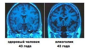 Алкогольная энцефалопатия - тоже забавное словосочетание.