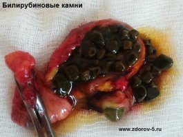 У любительницы жирной пищи обнаружили 2 тысячи желчных камней