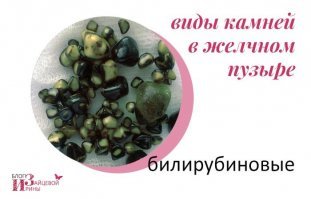 У любительницы жирной пищи обнаружили 2 тысячи желчных камней