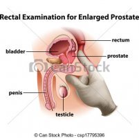 Способ сохранения "истинной простаты"