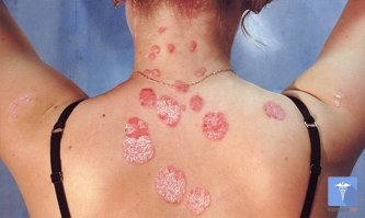 Это ни разу не сифилис. Это псориаз. До сих пор неизлечим.