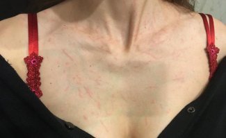 Помимо арахнофобии, есть ещё одно маленькое "но"... Коготки на лапках крупных пауков. В данном случае - последствия фотосессии с пауком-птицеедом: