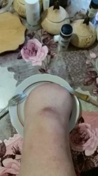 От моего друга Саши. С его разрешения. Это колено.