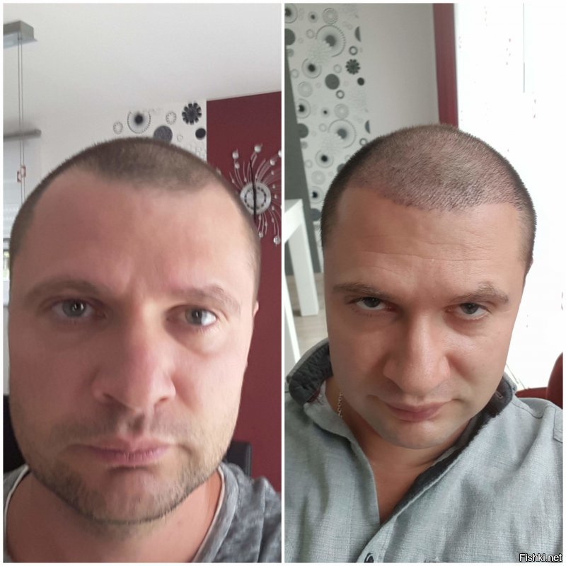 фото до и после, справа 3 недели после операции
