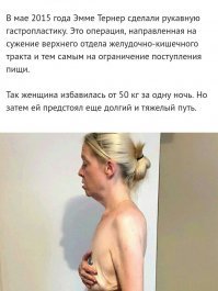 Тушенкина, ты вообще читаешь что копипастишь?

После операции, женщина за одну ночь потеряла 50кг.
А потом, после удаления фартука ещё 50кг.

Как можно потерять за одну ночь 50кг?
Ты дура чтоли?