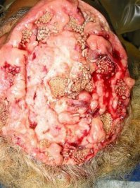 Вот, скопипастил (на фотки излишне впечатлительным советую не смотреть, если получится :) ) - 

Мистер Шота Фудживара из японской префектуры Гифу очень любил суши и сушими. Он любил их настолько, что всегда старался потреблять их максимально "живыми и свежими". 

Однако последние 3 года его стали мучить тяжелые головные боли, которые он поначалу списал на мигрень и стресс от работы. Лишь только тогда, когда начали нарушаться психомоторные функции, он решил обратиться к врачу. 

Сканирование мозга и рентген мало что показали. Однако, внимательно обследовав скальп, доктор заприметил небольшие движения под кожей. Во время же проведения локальной анестезии, врачом были замечены маленькие червячки, выползающие наружу. Сразу же было сделано серьезное хирургическое вмешательство. Масштабы заражения привели врачей в ужас! 

А мы напоминаем вам, дорогие любители суши, что ленточные и круглые черви, а также их яйца, которые имеются в изобилии в любой рыбе, могут быть убиты только во время готовки на огне или заморозки до температуры 0-4  C. Яйца паразитов при заморозке погибают только через неделю. Так что, подумайте дважды, перед тем как будете есть суши в следующий раз!