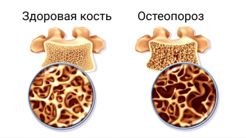 А при чём тут химия то?)) Если кальций природный элемент содержащийся в природных компонентах........

Можешь просто больше молочных продуктов потреблядь......можешь обычный школьный мелок есть.....Разницы никакой......

А из-за недостатка кальция и развивается хрупкость костей в возрасте.......

Другое дело гибкость суставов.....но и тут помогут обычные вещи.....