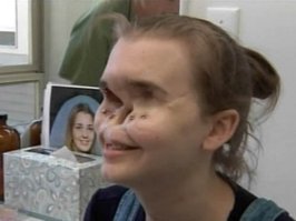 помню году 2006ом или 2007ом по телеку была программа "невероятная коллекция мистера Рипли", и в ней рассказывалось об американце, который занес плесень с хлеба себе в глаза. По итогу хирурги удалили оба глаза и нос. И пришлось ему жить дальше с лицевым протезом. Выглядел он примерно как женщина на фото.
Историю помню хорошо. Но за достоверность фактов, рассказанных журналистами не ручаюсь.