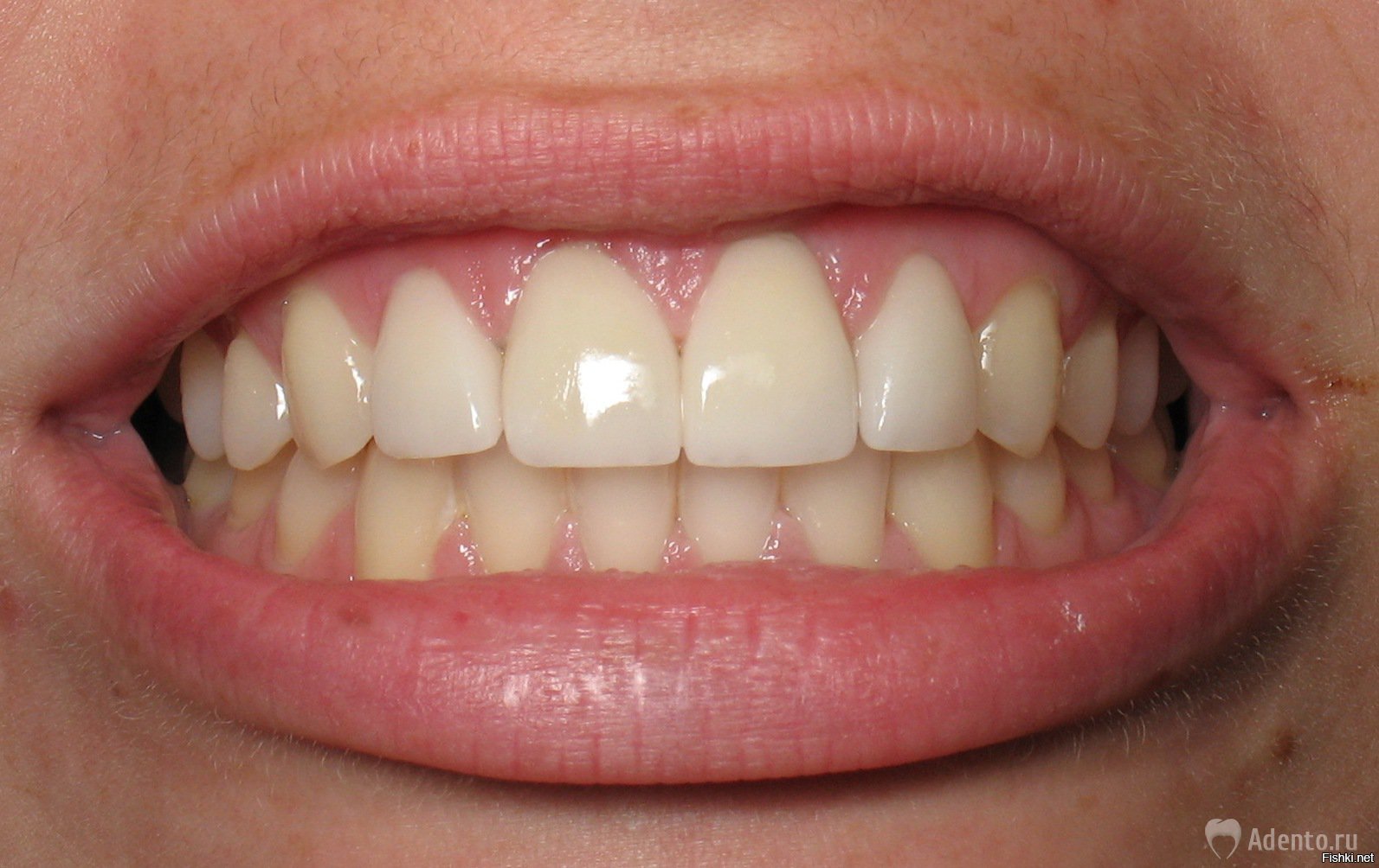 Клык сверху зубов. Зубы человека. Красивая форма зубов.