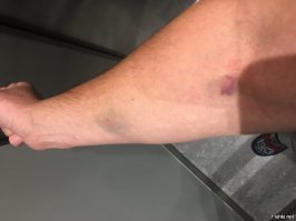 Честно раз пол года сдаю кровь и пол года чувствую себя отлично . Не знаю с чем это связано  Правда вот с годами ранки дольше заживают :) Фото пол часа назад , кровь забирали вчера в 8 утра