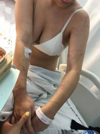 Женщина получила ужасные травмы после того, как её укусила медуза