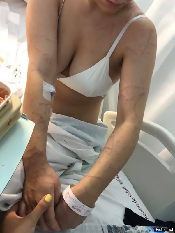 Женщина получила ужасные травмы после того, как её укусила медуза