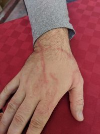 Мое знакомство с португальским корабликом на Кубе Варадеро это через сутки пальцы не двигались после укуса парализует на минут 30. Морфий не давали сукккккииии.....