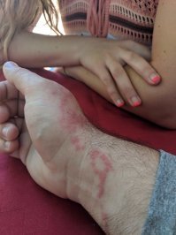 Мое знакомство с португальским корабликом на Кубе Варадеро это через сутки пальцы не двигались после укуса парализует на минут 30. Морфий не давали сукккккииии.....