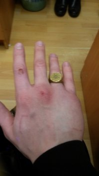 Ты хотя бы на второй день понял. А я две недели с переломом ходил, думал просто ушиб. Пошёл в больничку. Да, просидел два часа (это операции других людей и дезинфекция инструментов. Никто не роптал - все всё понимают). Да, сверлили кость... ну, может не Бошевской, а Метабовской дрелью. Пардон, а чем они плохи, скажите? На каталке возили в рентген, бесплатная анестезия, бесплатный рентген, бесплатные штыри, бесплатные перевязки в течение месяца.