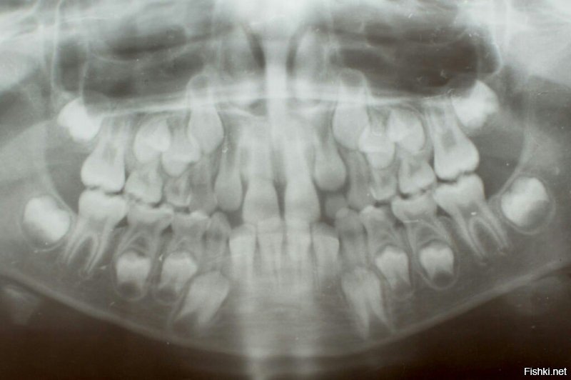Это снимок челюсти обычного 4-7 летнего ребенка. На нем мы видим молочные и коренные зубы. Вот вам еще: