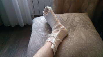 Такое наверно не скоро будут применять в обычных травмпунктах.А сейчас такие накладывают. Сломан большой палец,5 недель ношу уже.Завтра надюсь снимут.