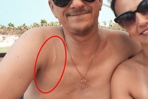 Много лет назад мне так электрическая Парма в плечо прилетела. Шинка без амортизатора, тормоза нет. Надо было балку отпилить (тоже держа пилу над собой), а внутри неё оказался штырь железный, носиком его и хватанул. Пилу на землю секунд 20 не мог поставить, пальцы не разжимались. Пять сантиметров левее и распилил бы себе голову...