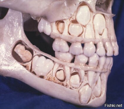 Вообще то корни у постоянных зубов, а молосные без корней на снимке видно анамалию развития, когда молочные остались внутри челюсти. А не смена зубов