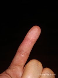 Неудачно проверил остроту ножа в юности.