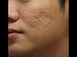 на счёт прививок, конкретно от оспы... 
в ссср прививали всех поголовно, понятия "антипрививочник" отсутствовало, как класс. без справки о всех положенных прививках тебе была закрыта дорога везде: дет/сад, пионерлагерь, школа, институт, работа, санаторий, бассейн и т. д.
граждан ссср за рубежом регулярно опознавали по шраму на руке от оспянной прививки.
так вот, мне в жизни частенько встречались люди, рождённые и выросшие в советском союзе, с изъеденными оспинами лицами. получается, что им прививки от оспы не помогли? да и где они могли подцепить оспу, если все вокруг были привитыми? это же не сибирская язва, которая может десятилетиями в скотомогильниках лежать и "не портиться".
если тут есть спецы в этой области, просветите, как такое возможно? прививки действуют не на всех? или у этих людей какая-то другая оспа была, от которой не прививали? ведь реально, советская медицина боролась с заразными болезнями, типа туберкулёза и тифа, всеми силами, вводя карантины и госпитализируя инфицированных, даже при помощи милиции и армии.
я не против прививок, просто, для общего развития, интересно - помогли ли остальным людям, и мне в частности, эти вакцины или нам просто посчастливилось не встретится в жизни с источником заразы?