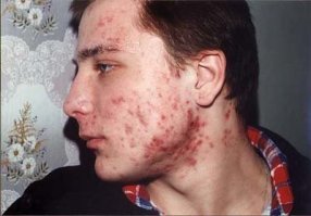 Взяли и сравнили девчонку с последствиями серьезного акне и мужика с беспроблемной от природы кожей. Мужики с акне тоже не айс.