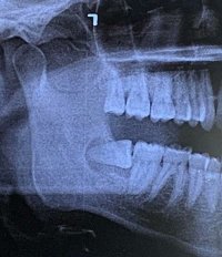 Да уж. У меня таких два зуба мудрости и все вот так поперек лежат. Живу с ними уже 30 лет.