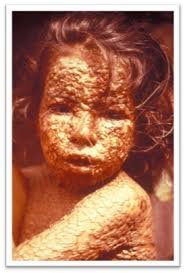 Вплоть до 20 века больных лепрой (проказа) обязали носить и звонить в колокольчик.....
.
вот вам и бубенцы, которых сторонились....