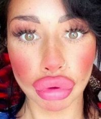 Девушка родилась с утиными губами. Страшная мутация, бывает один раз на миллион.