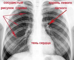 Я также думал но вот более чёткий снимок сердца.
Потом вспомнил что желудок накрыт печенью (рядом с ней), печень под диафрагмой, диафрагма под грудиной...