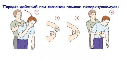 Метод Геймлиха
Согласно методу, человек, оказывающий помощь, должен встать за спиной пострадавшего, затем сжать одну руку в кулак и положить её на живот тому, кто в тот момент задыхается. Ладонь другой руки кладётся поверх кулака, быстрым толчком вверх кулак вдавливается в живот.