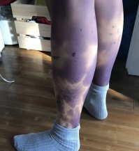 Это не синяки.. Это уже трупные пятна или гангрена походу...