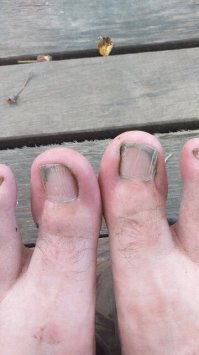 Правый 30 лет назад вырезано боковое, теперь растет внутри, левый когда погиб Цой, срывали полностью, наркоз местный,отходит жуть, а всё это нищета конца 80-х начала 90-х, небыло денег на новую обувь....