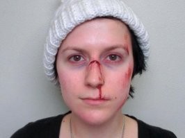 Ничего не хочу сказать, но перелом точно не так выглядит. Весь нос кровью забит, синяки под глазами. Говоришь хреново и дышишь ртом.
Максимум сливу поставили 

При этом определить перелом у пострадавшего можно по следующим признакам:

кровотечение от умеренного до интенсивного;
синдром «очков» из-за сильной отёчности;
изменённая форма носа;
дыхание носом или сильно затруднено, или вообще невозможно;
покраснение белков глаза;
гематома в области носа.
В этом случае полное восстановление может занять от одного до нескольких месяцев.