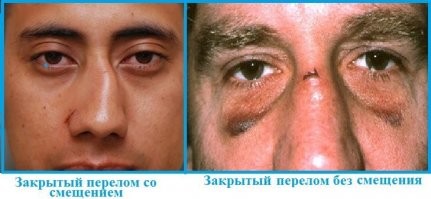 Ничего не хочу сказать, но перелом точно не так выглядит. Весь нос кровью забит, синяки под глазами. Говоришь хреново и дышишь ртом.
Максимум сливу поставили 

При этом определить перелом у пострадавшего можно по следующим признакам:

кровотечение от умеренного до интенсивного;
синдром «очков» из-за сильной отёчности;
изменённая форма носа;
дыхание носом или сильно затруднено, или вообще невозможно;
покраснение белков глаза;
гематома в области носа.
В этом случае полное восстановление может занять от одного до нескольких месяцев.