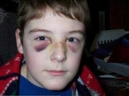 При переломе носа вокруг глаз огромные синяки, вот такие. Где они у Собчак?