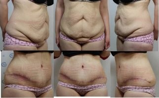 Чем терминальнее стадия ожирения, тем больше и заметнее шрамы после удаления лишней кожи.