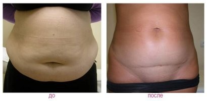 Чем терминальнее стадия ожирения, тем больше и заметнее шрамы после удаления лишней кожи.