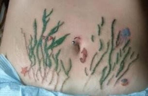 клево растяжки после беременности убрали))