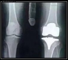 Сделал рентген колена, хирург убежал)))