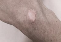 Рубцовая ткань состоит из коллагена, в ней нет потовых желез.