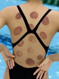 Многие спортсмены ставят банки. Улучшает кровообращение в мышцах.